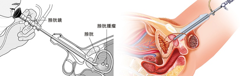 health-pic-cystoscopy.png